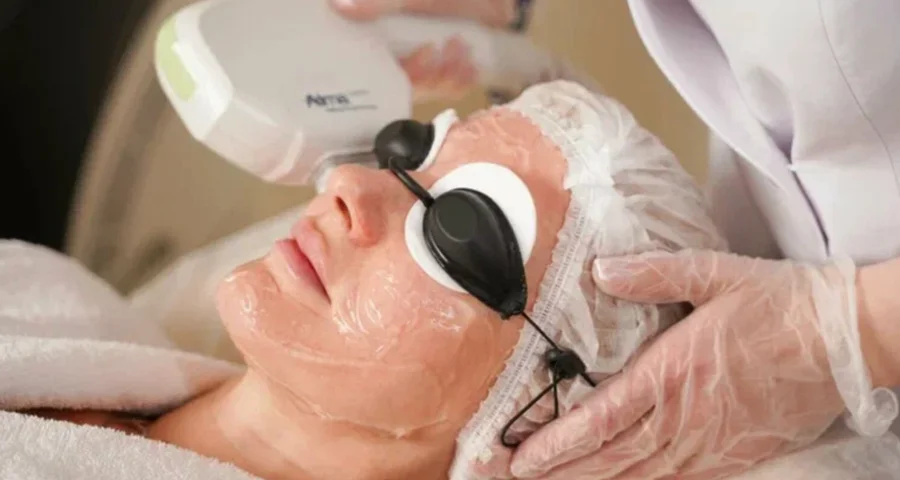 Dye-VL Facial